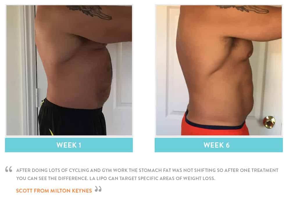 Before & After Stomach Fat Vauxhall