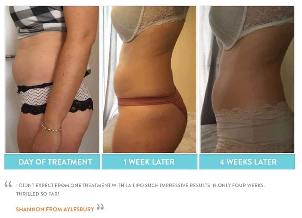 before, Cryolipolysis Vauxhall