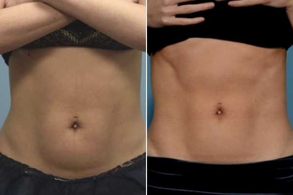 body sculpting FAQs Vauxhall
