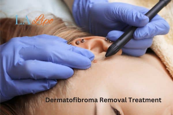 Dermatofibroma Removal Treatment Vauxhall