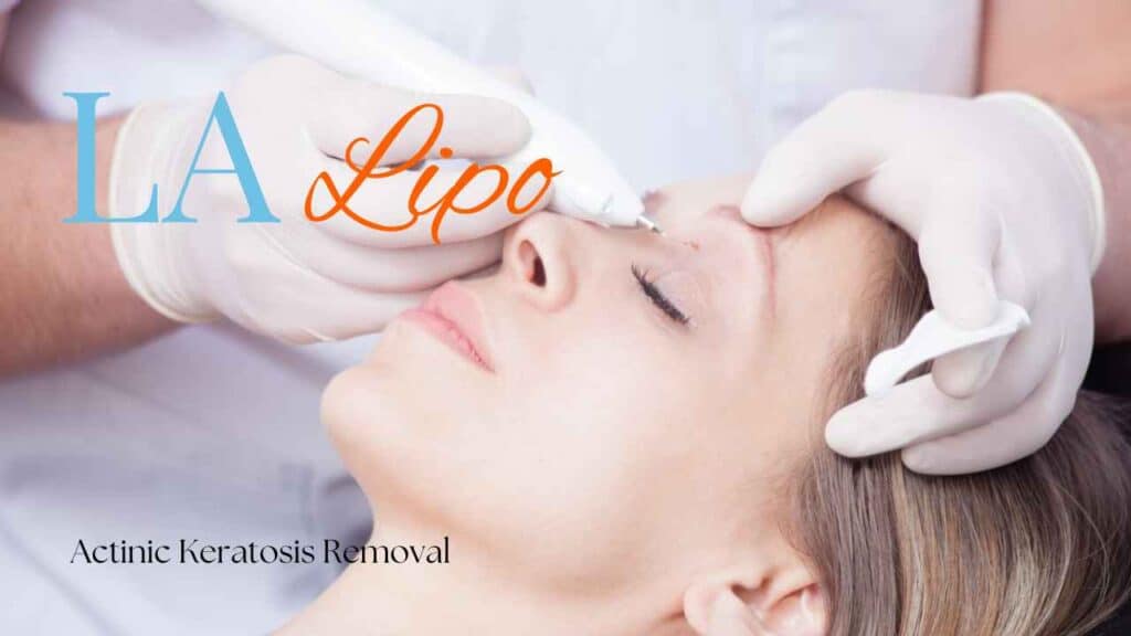 actinic keratosis removal Vauxhall