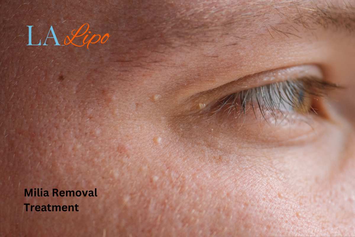 Cryopen Milia Removal: Is It the Easiest and Safest Option Vauxhall?