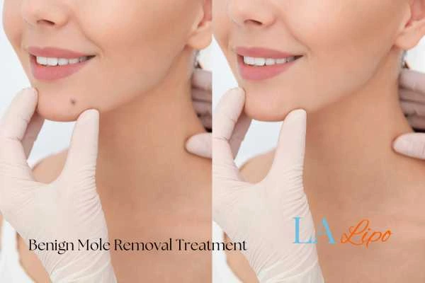 Before-and-after results following benign mole-removal treatment Vauxhall
