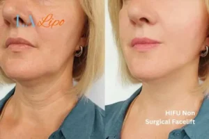 hi-fu for wrinkles Vauxhall before and after results