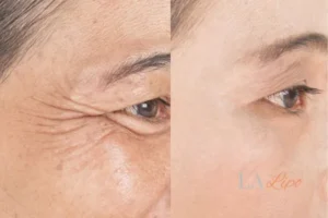 Before and after results of woman - HI-fu wrinkles reduction treatment Vauxhall