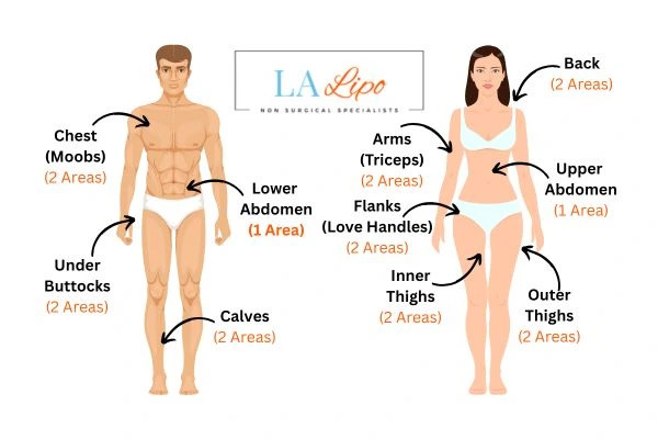 LA LIPO Cryolipolysis Areas Vauxhall