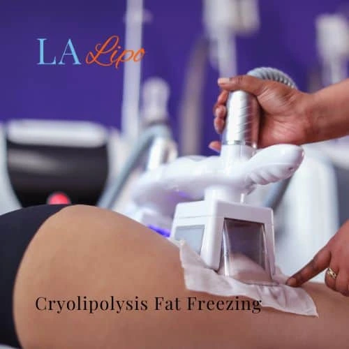 fat freezing - Cryolipolysis Vauxhall