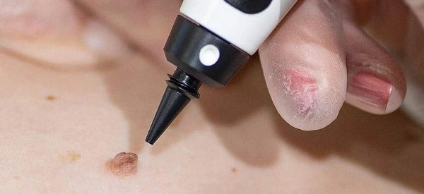 skin tag removal using cryopen Vauxhall