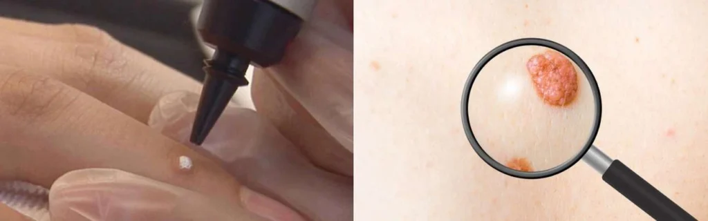 CryoPen practitioner Vauxhall assessing a benign mole before treatment