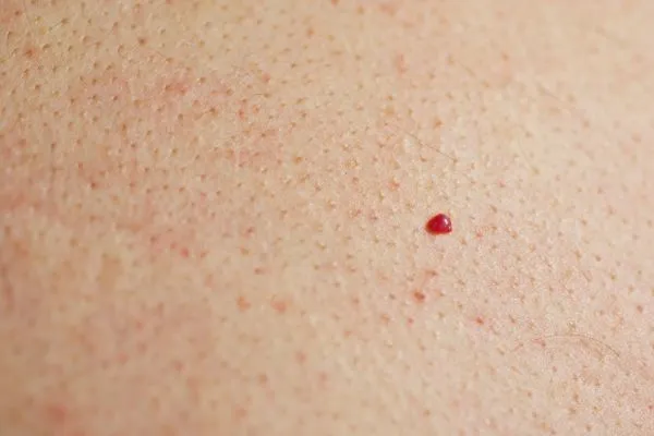 close up of a cherry angioma Vauxhall