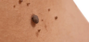 image of a skin tag Vauxhall