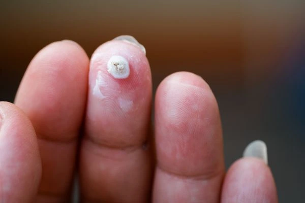 wart on person finger - cryotherapy to treat from LA LIPO Vauxhall