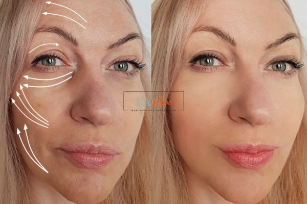 Morpheus 8 results Vauxhall face lift.