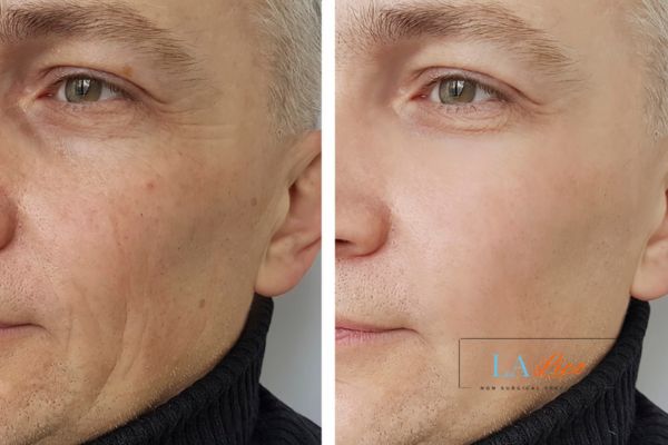 See the amazing results of Morpheus8 Treatment Vauxhall!