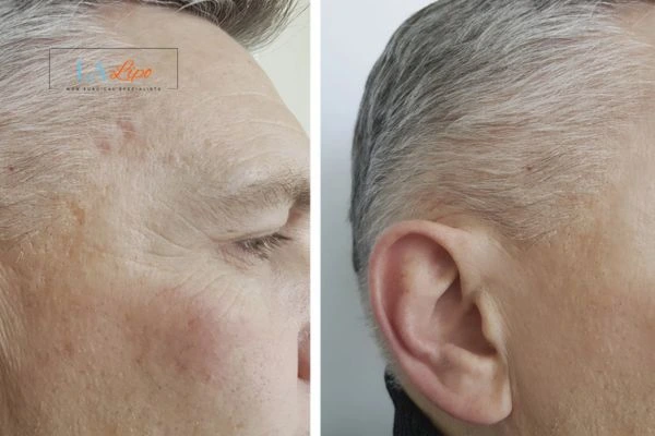 Mens Before & After Morpheus 8 Results Vauxhall