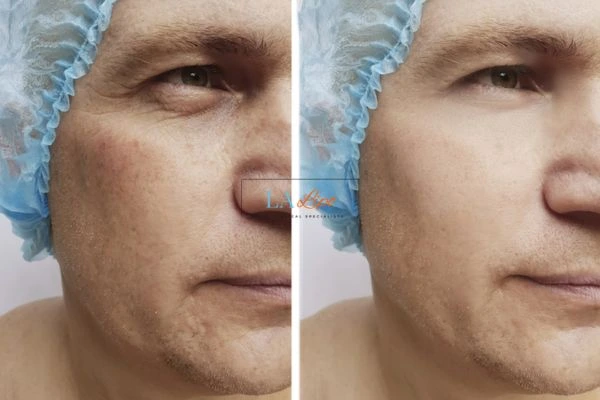 Before and after Morpheus 8 Results Vauxhall