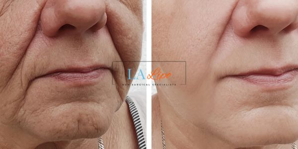 Older lady deeper wrinkle reduction - LA LIPO Morpheus 8 Results Vauxhall