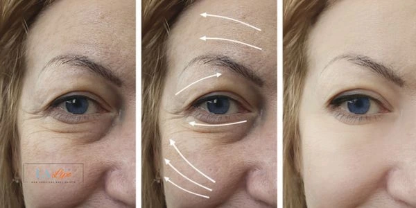 Amazing eye lift Morpheus 8 results Vauxhall