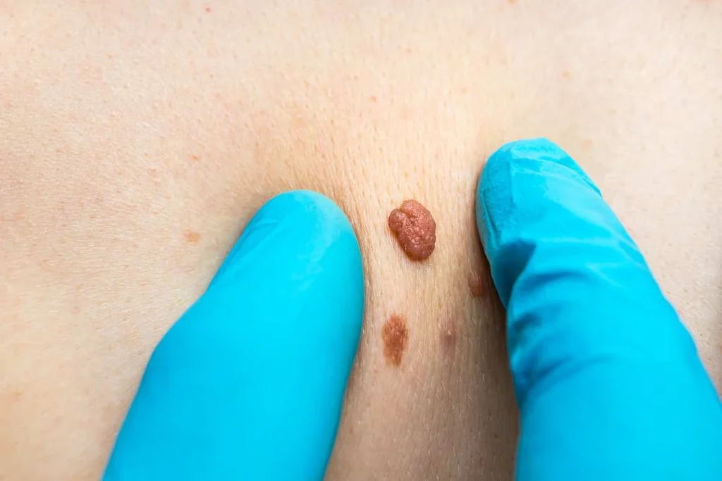 LA LIPO Cryopen Lesion Removal Prices Vauxhall