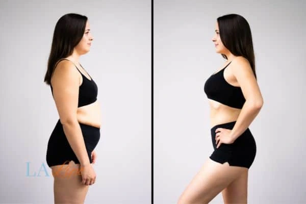 Picture of womans before and after using LA-EMS body sculpting to improve her core strength Vauxhall