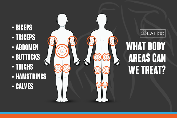 Diagram to show areas you can have LA-EMS Body Sculpting Treatment Vauxhall
