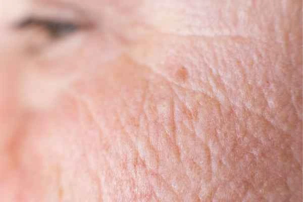 close up picture of a woman's face showing an age spot Vauxhall