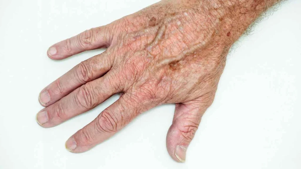 Male hand showing age spot Vauxhall