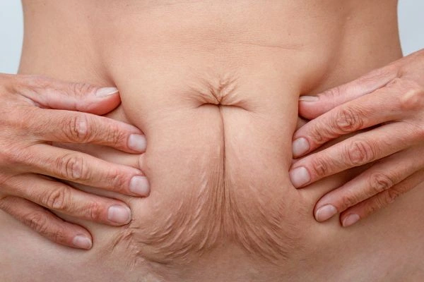 Image of a woman's stomach with loose skin - example of skin tightening Vauxhall options
